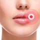 Illustration for article titled How to Manage Herpes When It’s Awakeem/em